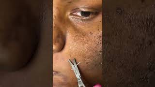 Trimming dead skin  Chemical Peel  Hyperpigmentation Removal [upl. by Cindy]