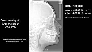 Herbst Vs IMDO jaw distraction for short lower jaw and dental overjet overbite before and after [upl. by Trout128]