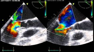 ACUTE PULMONARY OEDEMA due to ECLIPSED FUNCTIONNAL MITRAL REGURGITATION ECHOCARDIOGRAPHY [upl. by Notlrac]