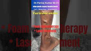 Varicose veins treatment for SSC GD medical Best varicose veins treatment shorts varicoseveins [upl. by Conlan]