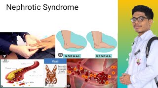 Nephrotic Syndrome  Signs and Symptoms of Nephrotic Syndrome [upl. by Clara]