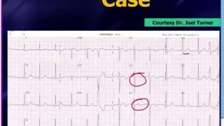 Mattu EKG Vakası 1 Temmuz 2013 Türkçe Altyazılı [upl. by Antons870]