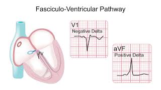 How to Recognize Atypical Pathways During Sinus Rhythm [upl. by Hubie517]