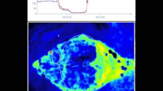 Cardiac Arrest  Perfusion Measurement in Brain [upl. by Cannell388]