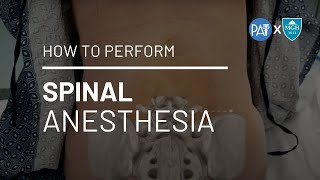 How to Perform Spinal Anesthesia [upl. by Christina]