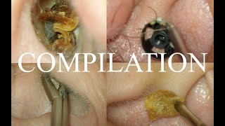 4 CASES  SEVERE EAR  COUGH REFLEX  CERUMEN IMPACTION  FOREIGN BODY  SYNDROMIC EARS [upl. by Tugman521]