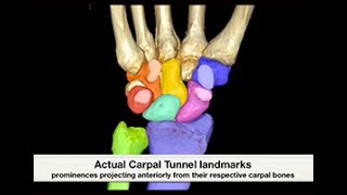 CS Carpal Tunnel Bifid Median Nerve  Sonosite [upl. by Etterrag371]