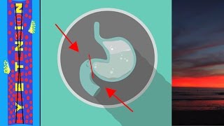 Pyloric Stenosis and Metabolic Alkalosis [upl. by Edgard]