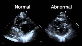 Echocardiogram from the Patient Compared with That from a Normal Control  NEJM [upl. by Florina866]