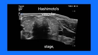 Stages of Hashimotos Thyroiditis Key Ultrasound amp color Doppler Findings Across Stages [upl. by Dorene]