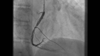 Philips Azurion Bifurcation proximale artère coronaire gauche [upl. by Vey]