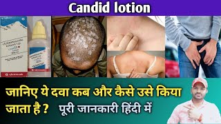 Candid lotion use dose benefits and side effects full review in hindi [upl. by Ezaria]