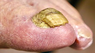 Super THICK BIG TOENAIL Trimming NAIL FUNGUS OR DAMAGED TOENAIL [upl. by Dnalevelc156]