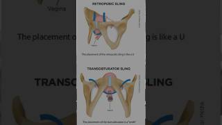 Stress incontinence in Females  Peshab ka leak hona shortsfeed shorts shortsviral [upl. by Adia798]