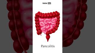 TYPES OF ULCERATIVE COLITIS आईबीडी का एक प्रकार tata1mg inflammatoryboweldiseases [upl. by Nich]