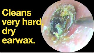 Cleans very hard dry earwax ear wax removal  ear cleaning  ASMR  relaxation  relax [upl. by Othilia]