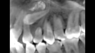 Canines incluses CBCT scan impacted cuspids orthodontie 123213 IT31 [upl. by Nelyahs483]