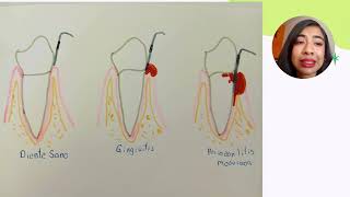 Métodos de diagnostico periodontal Cruz Benavides Karina [upl. by Acirrehs]