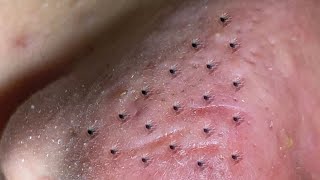 Suri Job 548 Amazing Blackheads and Inflamed Acne Extraction [upl. by Fisuoy]