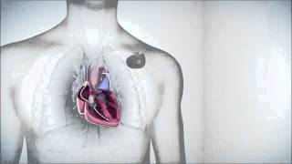 icd implantable cardioverter defibrillator  worlds single chamber ICD wwwpacemakercomhk [upl. by Ireva]