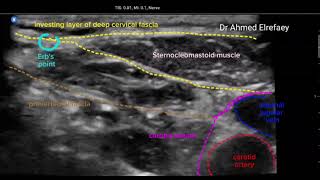 Intermediate cervical plexus block [upl. by Aninat]