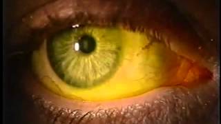 Instilling Fluorescein Dye in the Eye [upl. by Effy]