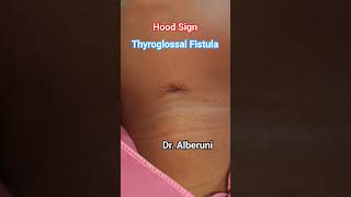 Hood Sign of Thyroglossal Fistula [upl. by Salomone538]