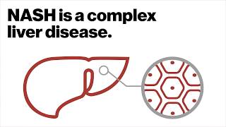 Multipronged approach for complex liver disease [upl. by Druci]