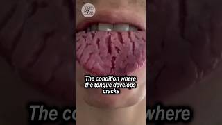 Exploring Fissured Tongue A Painful Condition with Unknown Causes [upl. by Coffin]