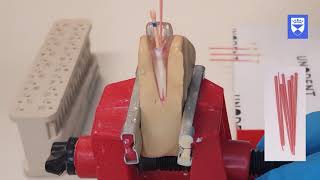 Endodontic treatment of the single rooted tooth Part 6 Obturation [upl. by Acissj]