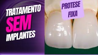 TRATAMENTOS SEM IMPLANTE DENTÁRIO  PROTESE FIXA PARCIAL PPF [upl. by Drannel636]