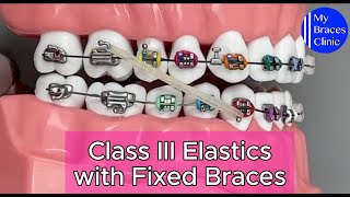 How to wear Class III Elastics with Fixed Braces [upl. by Ocihc659]