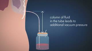 Advantages of regulated suction in a drainage system physical explanation for nurses and physicians [upl. by Pardo]