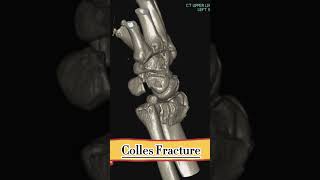 Colles Fracture  radiology viral shorts [upl. by Laved]