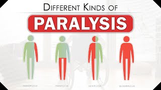 Different Kinds of Paralysis  How Does Someone Become Paralyzed  Types of Paralysis  SRIAAS [upl. by Erhart228]