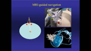 Neurosurgery On the Go Stereotaxis in NeuroOncology [upl. by Idnahk390]