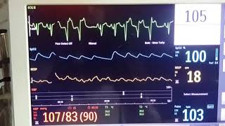 Ventricular Bigemini and Trigemini [upl. by Luedtke]