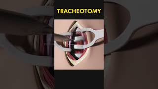 Tracheotomy 😷 explained [upl. by Alliuqa61]