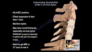 Ankylosing Spondylitis Of The Cervical Spine  Everything You Need To Know  Dr Nabil Ebraheim [upl. by Anada889]