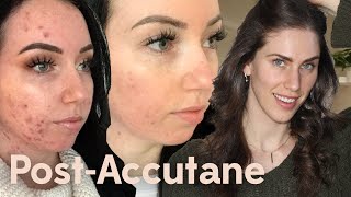 Post Accutane Acne Skincare Routine [upl. by Attennhoj]