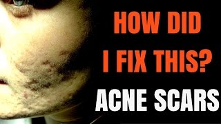 How to treat acne scars  Dermatologist explains [upl. by Yzzik]