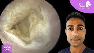 1371  Typical Ear Wax Removal amp Dead Skin Peel Clinic 9 Procedures [upl. by Aimal196]