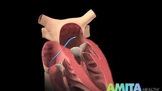 What Is Catheter Ablation — AMITA Health [upl. by Keener258]