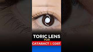 Toric Lens for Cataract Surgery Cost [upl. by Yentrok]