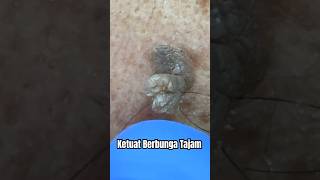 LASER KETUAT TUMBUH BERBUNGA TAJAM COMEL  DrMan Ttdi Story [upl. by Ardolino109]