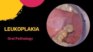 Leukoplakia  White Patch  Oral Pathology  Neet MDS  Dental Care [upl. by Drarreg59]