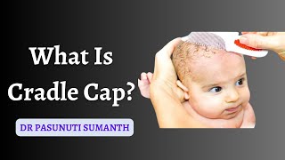 What is Cradle Cap amp its Treatment  Dr Pasunuti Sumanth [upl. by Yla416]