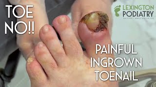 TOE NO Painful Ingrown Toenail Removal [upl. by Ayana]