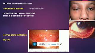 sarcoidosis and uveitis [upl. by Aytac]