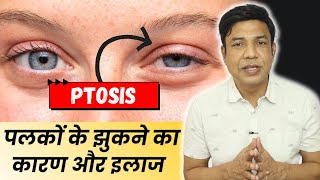 Ptosis of the Eye What You Need to Know Don’t Miss Out🔥 [upl. by Durstin]